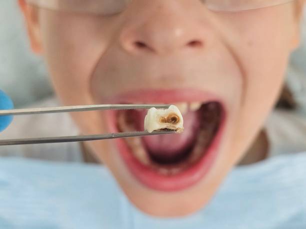 Best Knocked-Out Tooth Emergency  in Blue Earth, MN